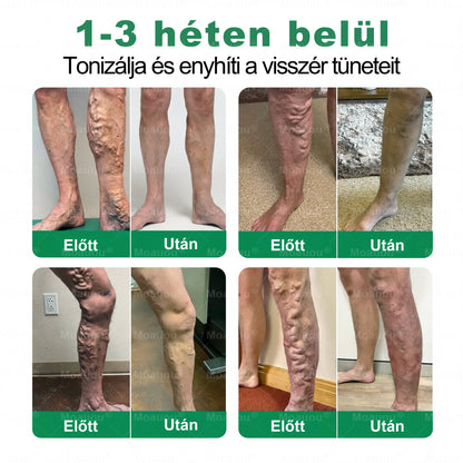 🌿🌿Moauou® Visszérápoló Mikrotűs Tapasz –👨‍⚕️Célzott ápolás fáradt, nehéz és feszülő lábakra | NAGY AKCIÓ!