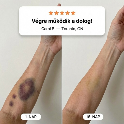 🔥100K+ ELADVA 💁‍♀️ – 💜PuraCure® Zúzódásjavító és bőrerősítő krém