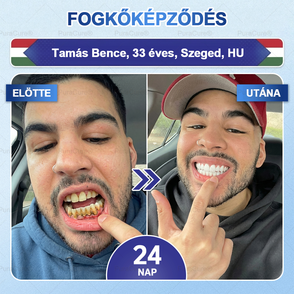 🦷🦷PuraCure® többhatású fog- és ínyregeneráló szájvíz | Kollagén × posztbiotikumok × β-glükanáz