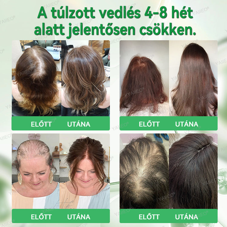 🫒🫒🫒YAIIEO® Fájdalommentes Mikroinfúziós Hajhullás Elleni Rendszer – ✅DHT-Blokkolás, Hajhagymák Újraélesztése és Látványosan Dúsabb Haj