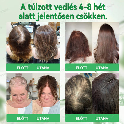 🫒🫒🫒YAIIEO® Fájdalommentes Mikroinfúziós Hajhullás Elleni Rendszer – ✅DHT-Blokkolás, Hajhagymák Újraélesztése és Látványosan Dúsabb Haj