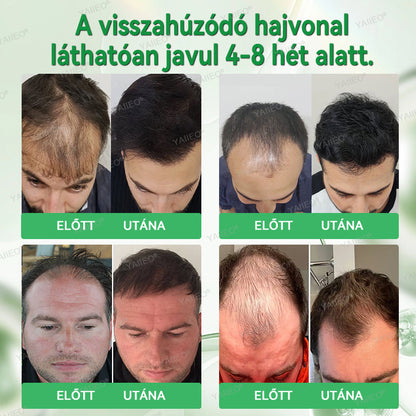 🫒🫒🫒YAIIEO® Fájdalommentes Mikroinfúziós Hajhullás Elleni Rendszer – ✅DHT-Blokkolás, Hajhagymák Újraélesztése és Látványosan Dúsabb Haj
