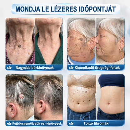 PuraCure® 👩‍⚕️👩‍⚕️👩‍⚕️𝟕 𝐍𝐚𝐩𝐨𝐬 Bőrkinövés- és Folteltávolító Toll Fájdalommentes és Hegmentes Professzionális Rollerball