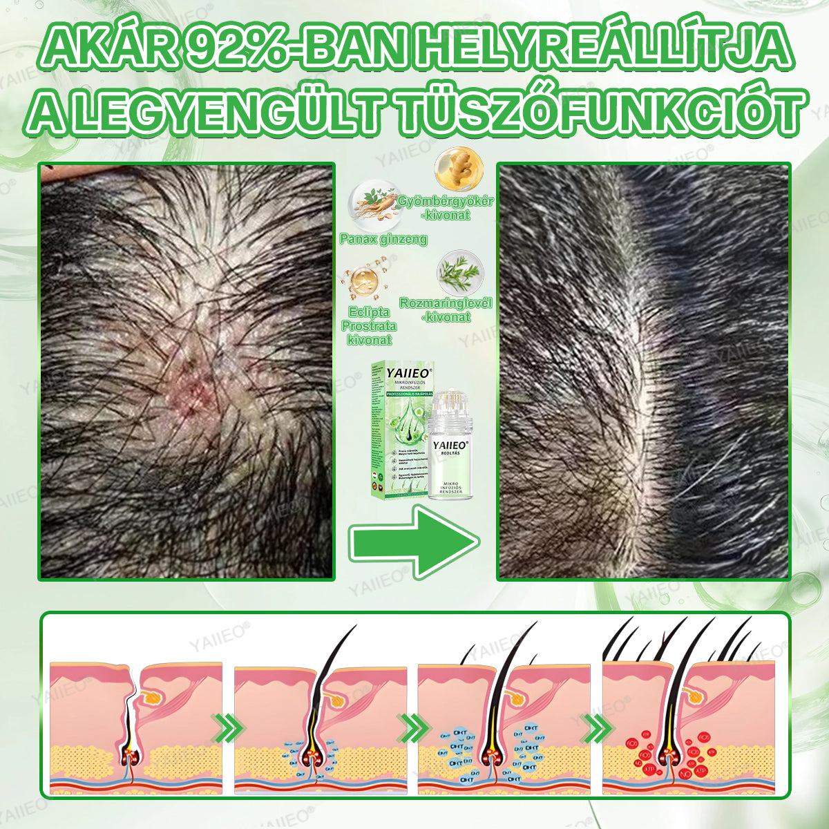 🫒🫒🫒YAIIEO® Fájdalommentes Mikroinfúziós Hajhullás Elleni Rendszer – ✅DHT-Blokkolás, Hajhagymák Újraélesztése és Látványosan Dúsabb Haj