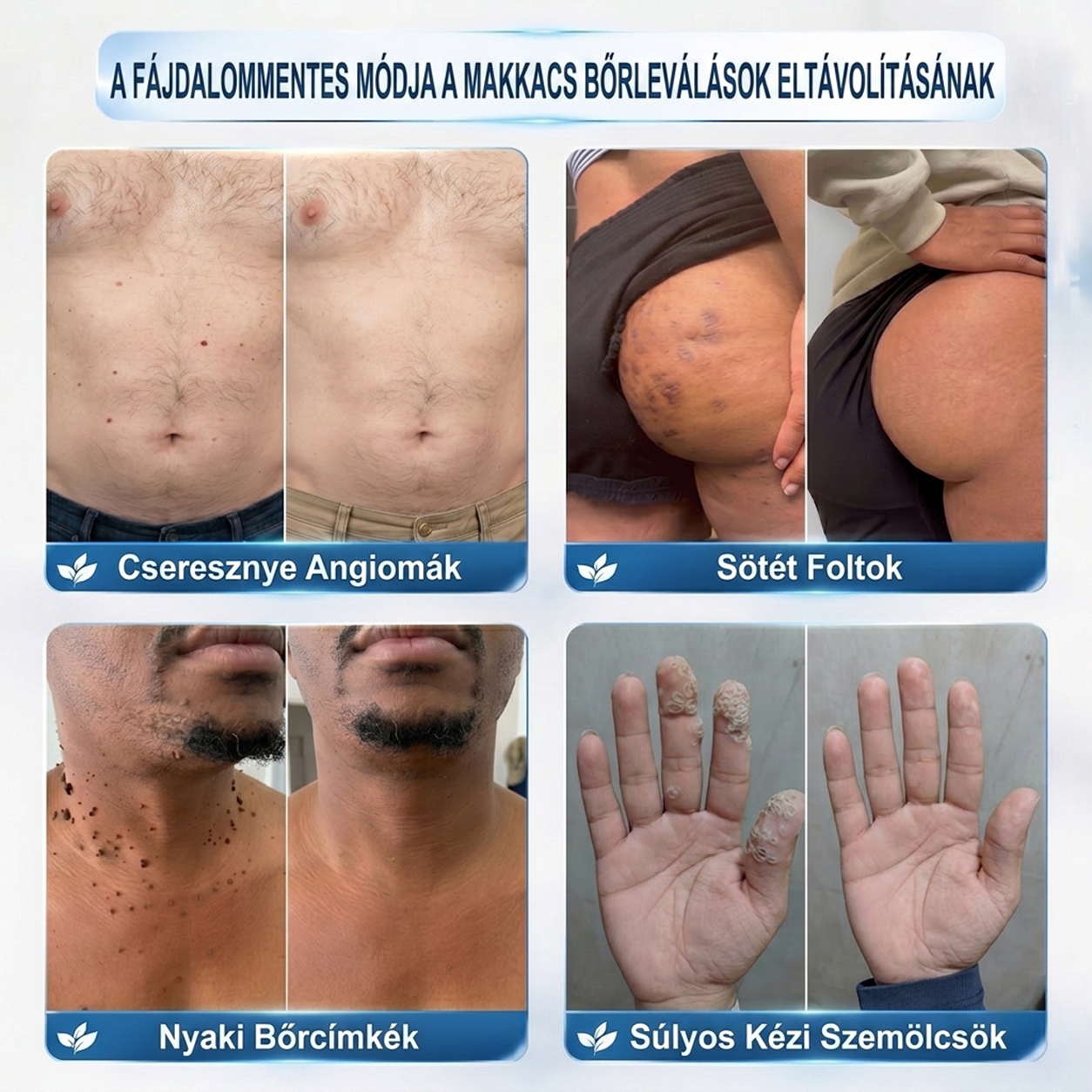 PuraCure® 👩‍⚕️👩‍⚕️👩‍⚕️𝟕 𝐍𝐚𝐩𝐨𝐬 Bőrkinövés- és Folteltávolító Toll Fájdalommentes és Hegmentes Professzionális Rollerball
