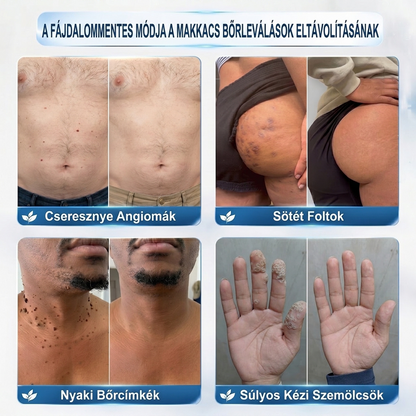PuraCure® 👩‍⚕️👩‍⚕️👩‍⚕️𝟕 𝐍𝐚𝐩𝐨𝐬 Bőrkinövés- és Folteltávolító Toll Fájdalommentes és Hegmentes Professzionális Rollerball