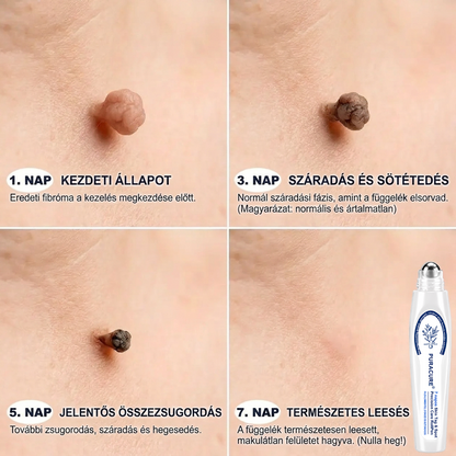 PuraCure® 👩‍⚕️👩‍⚕️👩‍⚕️𝟕 𝐍𝐚𝐩𝐨𝐬 Bőrkinövés- és Folteltávolító Toll Fájdalommentes és Hegmentes Professzionális Rollerball