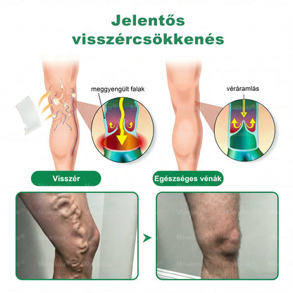 🌿🌿Moauou® Visszérápoló Mikrotűs Tapasz –👨‍⚕️Célzott ápolás fáradt, nehéz és feszülő lábakra | NAGY AKCIÓ!