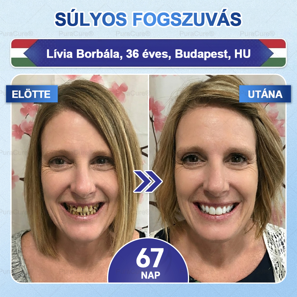 🦷🦷PuraCure® többhatású fog- és ínyregeneráló szájvíz | Kollagén × posztbiotikumok × β-glükanáz