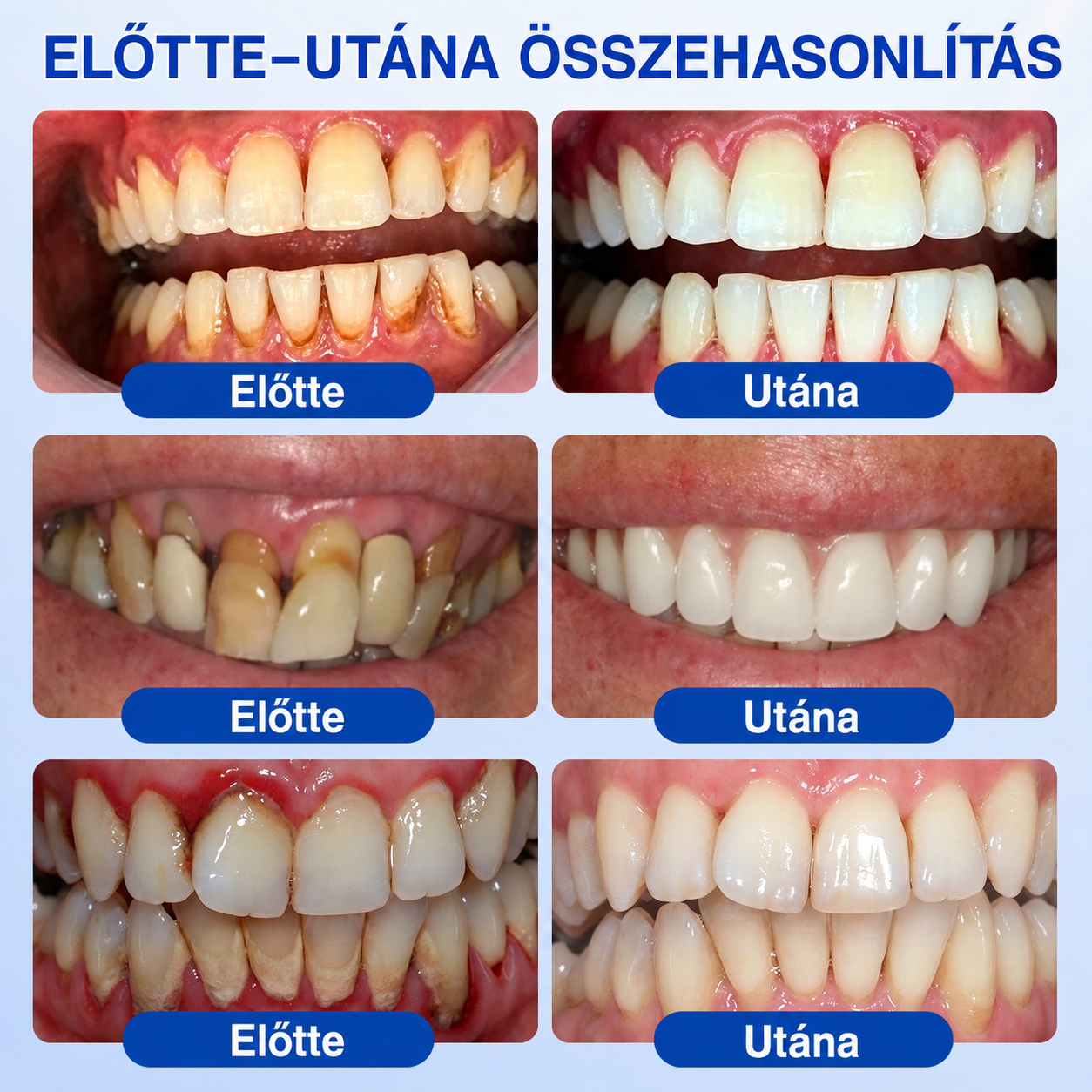 💧💧PuraCure® Ínymegújító – 🦷Célzott ínyápoló és regeneráló gél