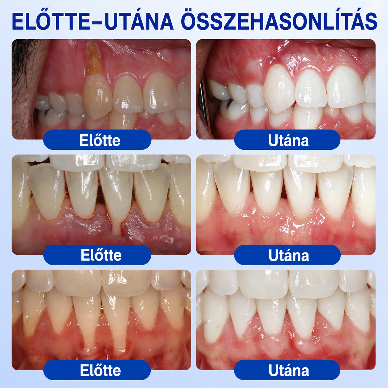 💧💧PuraCure® Ínymegújító – 🦷Célzott ínyápoló és regeneráló gél