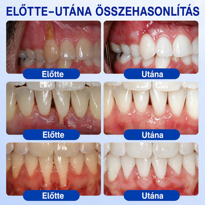 💧💧PuraCure® Ínymegújító – 🦷Célzott ínyápoló és regeneráló gél