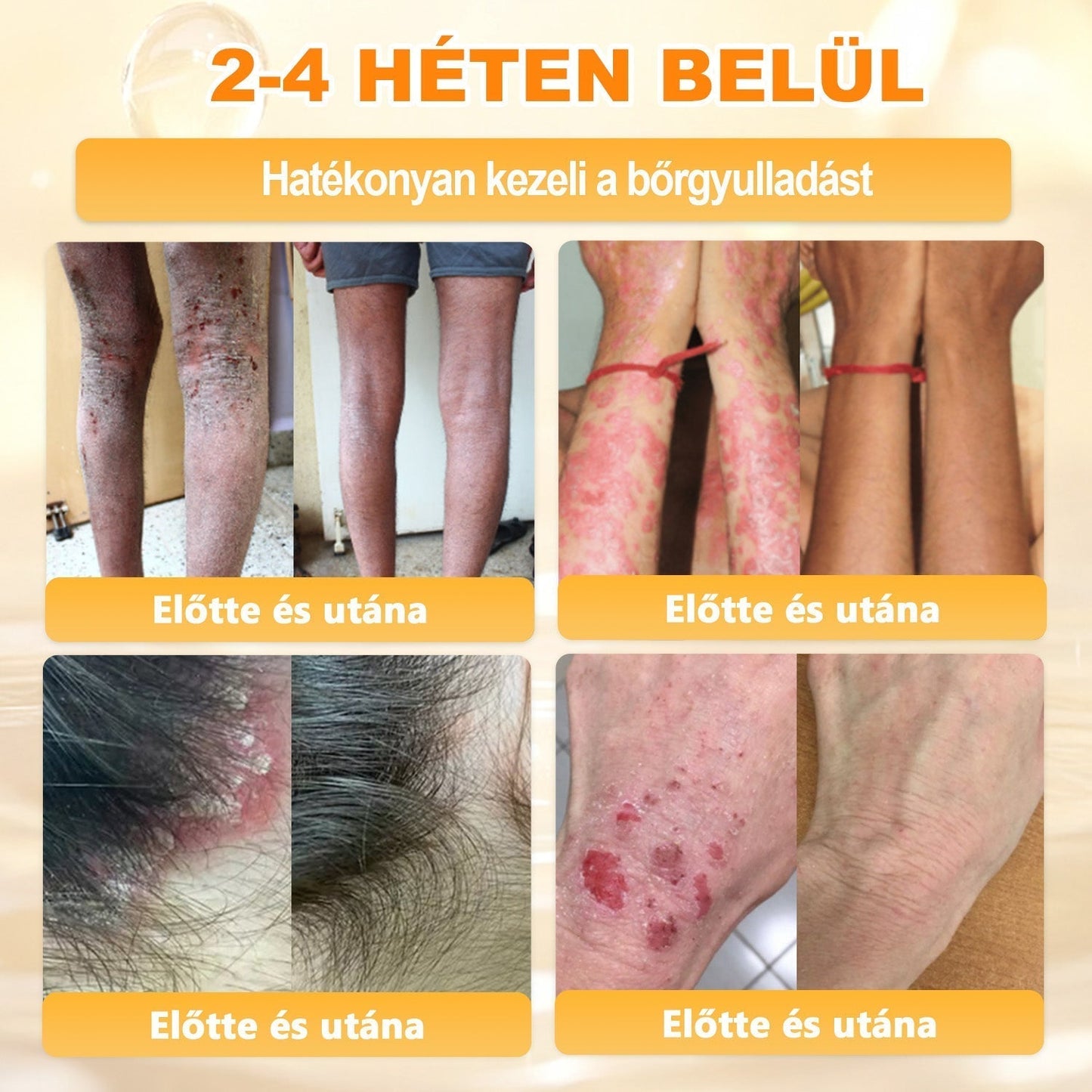 💛 𝐏𝐮𝐫𝐚𝐂𝐮𝐫𝐞® 𝐌é𝐡𝐦é𝐫𝐞𝐠 𝐁ő𝐫 𝐇𝐞𝐥𝐲𝐫𝐞á𝐥𝐥í𝐭ó 𝐊𝐫é𝐦 👨‍⚕‍CE Tanúsítvány ✅GMP-követő gyártási folyamat