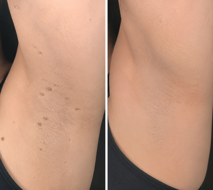 💫PuraCure® 2 az 1-ben mikrotűs és hidrokolloid tapasz 🧑‍⚕️ | Kiálló anyajegyek, aknék, lapos szemölcsök és bőrnövedékek eltávolítására | Segít csökkenteni a ráncokat, hegeket és bőrhibákat | Láthatatlan tapasz az arcra és testre