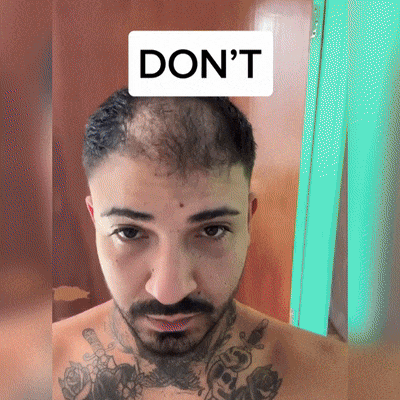 🫒🫒🫒YAIIEO® Fájdalommentes Mikroinfúziós Hajhullás Elleni Rendszer – ✅DHT-Blokkolás, Hajhagymák Újraélesztése és Látványosan Dúsabb Haj